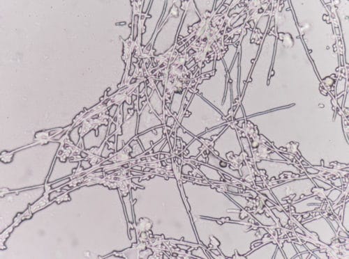 An overgrowth of Candida albicans cells in a urine sample